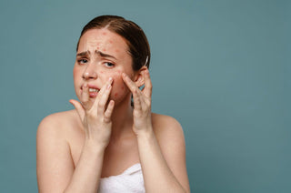 acne scars