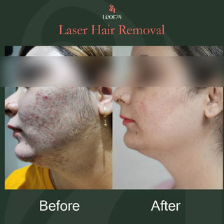 Hair Removal - Before & After Results