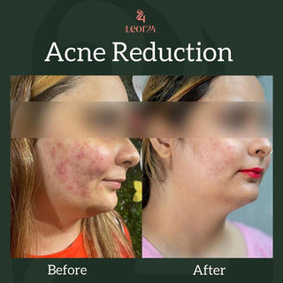 Acne Reduction Treatment - Before & After Results