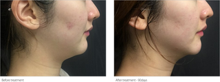 Skin Treatment - Before & After Results