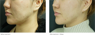 Skincare Treatment - Before & After Results