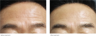 Wrinkle Treatment - Before & After Results