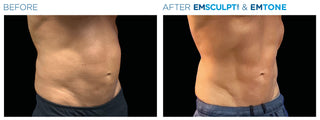 Fat Reduction Treatment at Leor Clinic