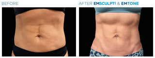 Abdomen threading - Before & After Results