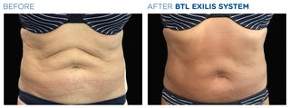 Abdomen Skin Treatment - Before & After Results
