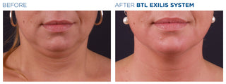 Liposuction - Before & After Results
