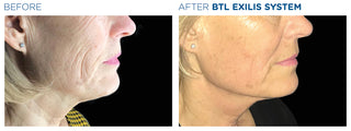Wrinkle Treatment - Before & After Results