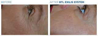 Face Skin Treatment - Before & After Results