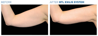 Arm Endolift - Before & After Results