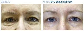 Eye bags treatment - Before & After Results