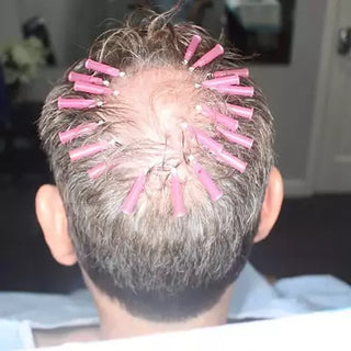 PDO Scalp Threading for Faster Hair Growth at Leor Clinic