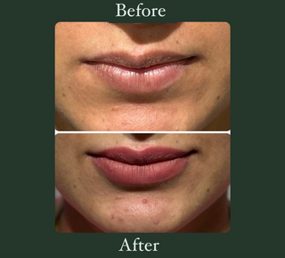 Lip filling treatment - Before & After Results