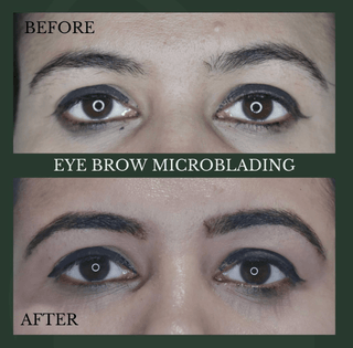 Eyebrow Microblading - Leor Clinic Skin Treatment Services