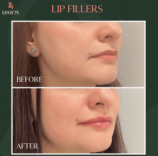 Lip Fillers - Before After 