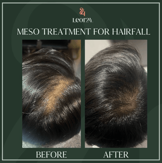 Meso treatment for hairfall - Before & After Results