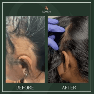 Hair regrowth treatment: before and after result