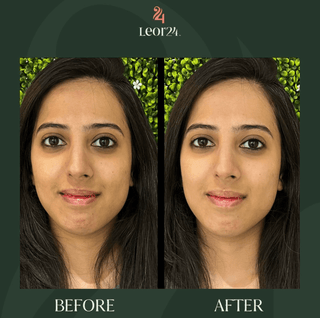 Anti Ageing - Before & After Results