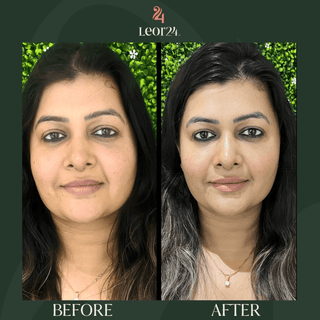 Facial treatment - Before & After Results