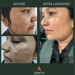 Skin Pigmentation Treatment Results at Leor Clinic
