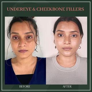 Undereye & Cheekbone filler - Before & After Result