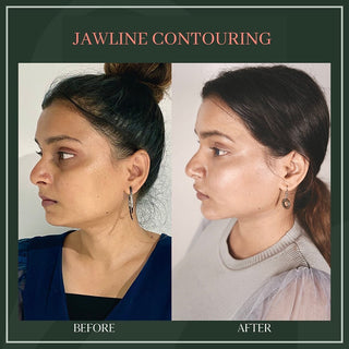 Jawline Contouring - Before & After Results