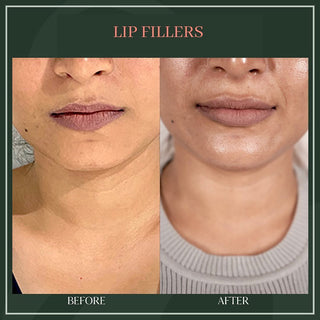 Lip Filler - Before & After Results