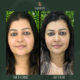Anti Ageing treatment - Before & After Results 