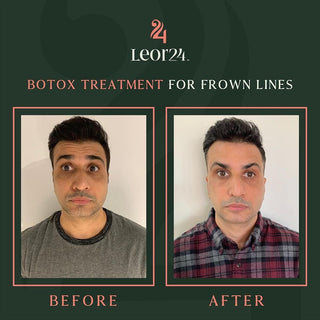 Botox Treatment - Before & After Results