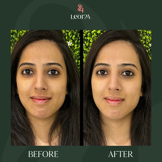 before after face skin treatment 