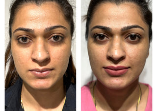 Lip filling treatment - Before & After Results