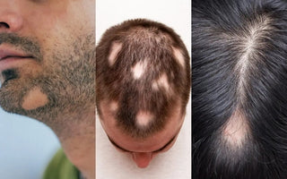 Man with Alopecia after treatment