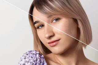 Before and After cosmetic Skin Treatment at Leor Clinic