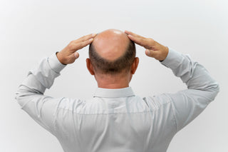 Bald Man Needing Follicular Extraction