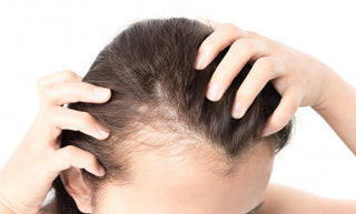 Baldness Patterns in Woman