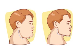 Liposuction illustration