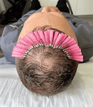 PDO Threading for Hair and Skin at Leor Clinic